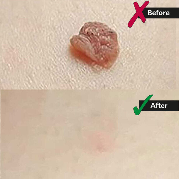 Skin Tag Removal Kit