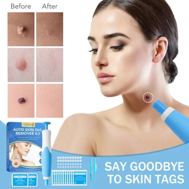 Skin Tag Removal Kit - Makfoul