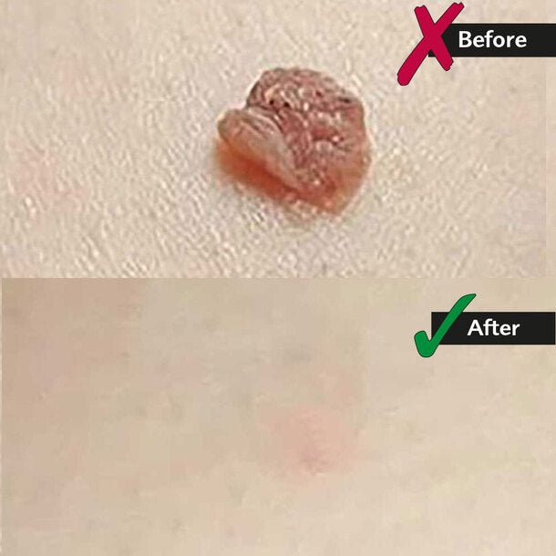 Skin Tag Removal Kit - Makfoul